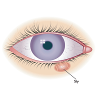 cyst eye style chalazion